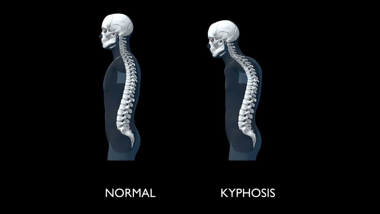 Media 1 for listing Kyphosis Comparision with Normal Human Spine