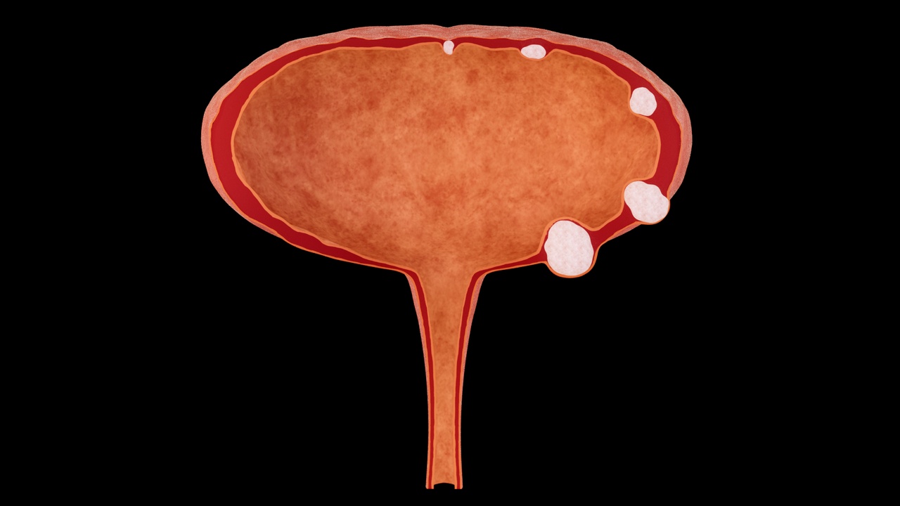 Media 1 for listing Bladder wall stones, bladder anatomy and lesions