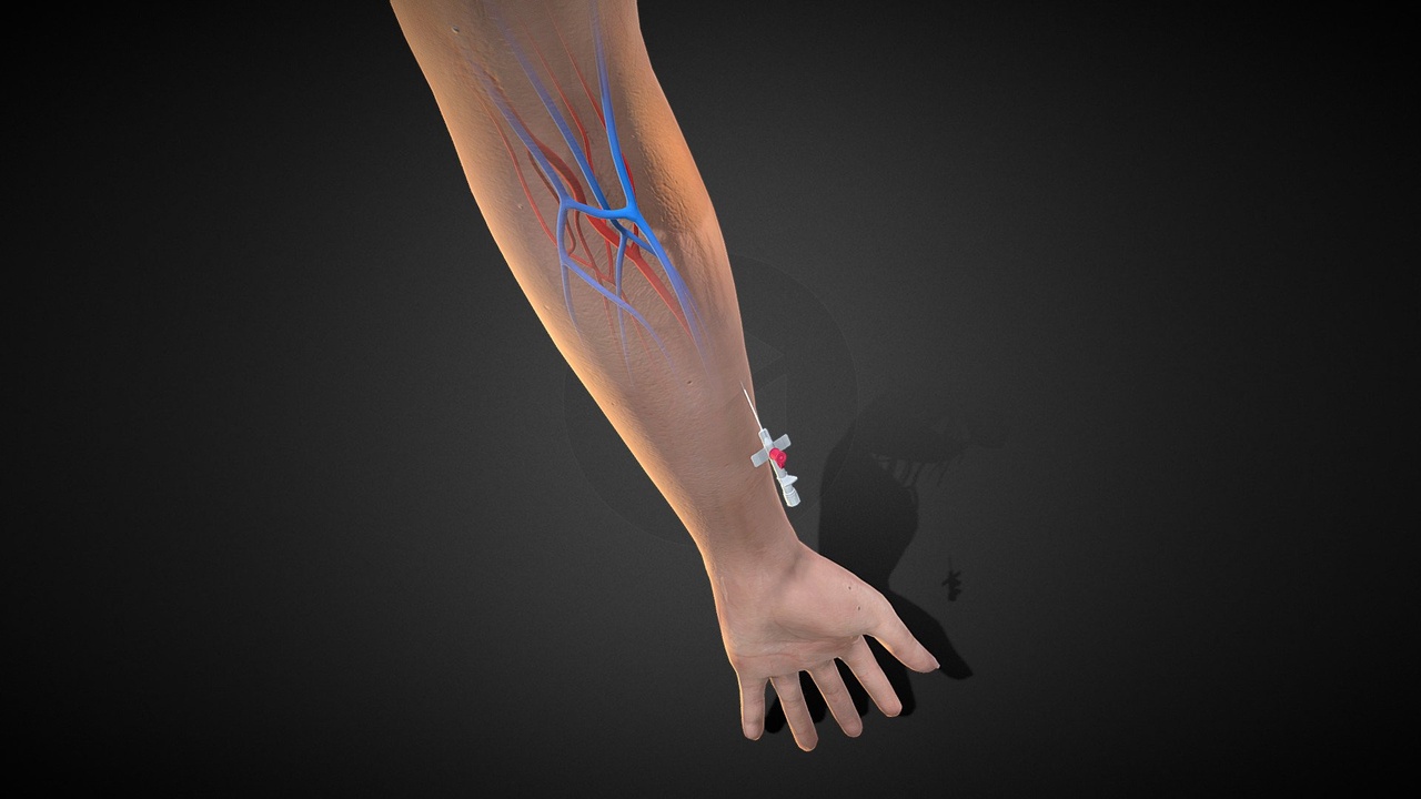 商品 3D Injected Cannula with sticking plaster 的媒体 1