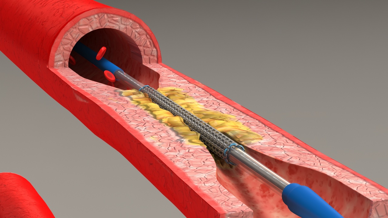 Media 1 for listing Stent Placement