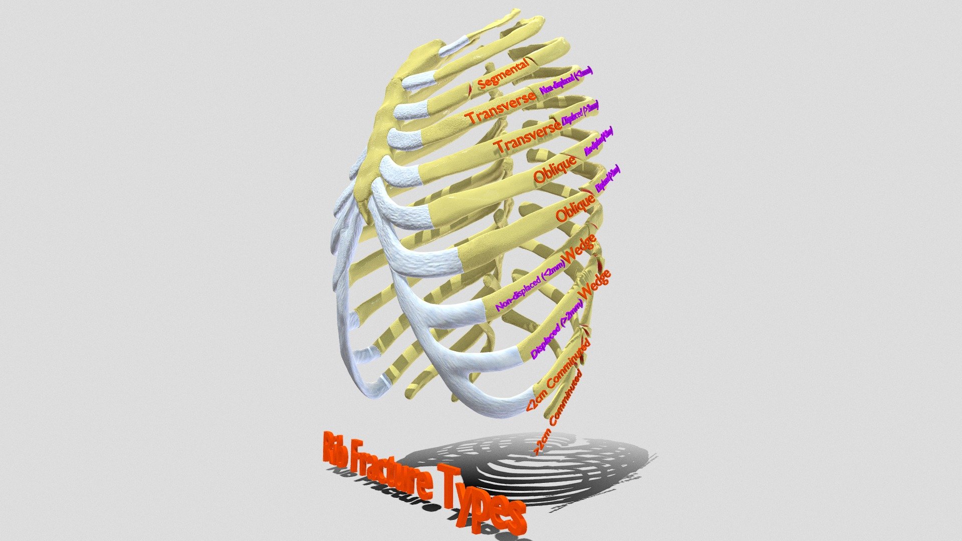 Buckled Rib Rib fracture and its types | Fab