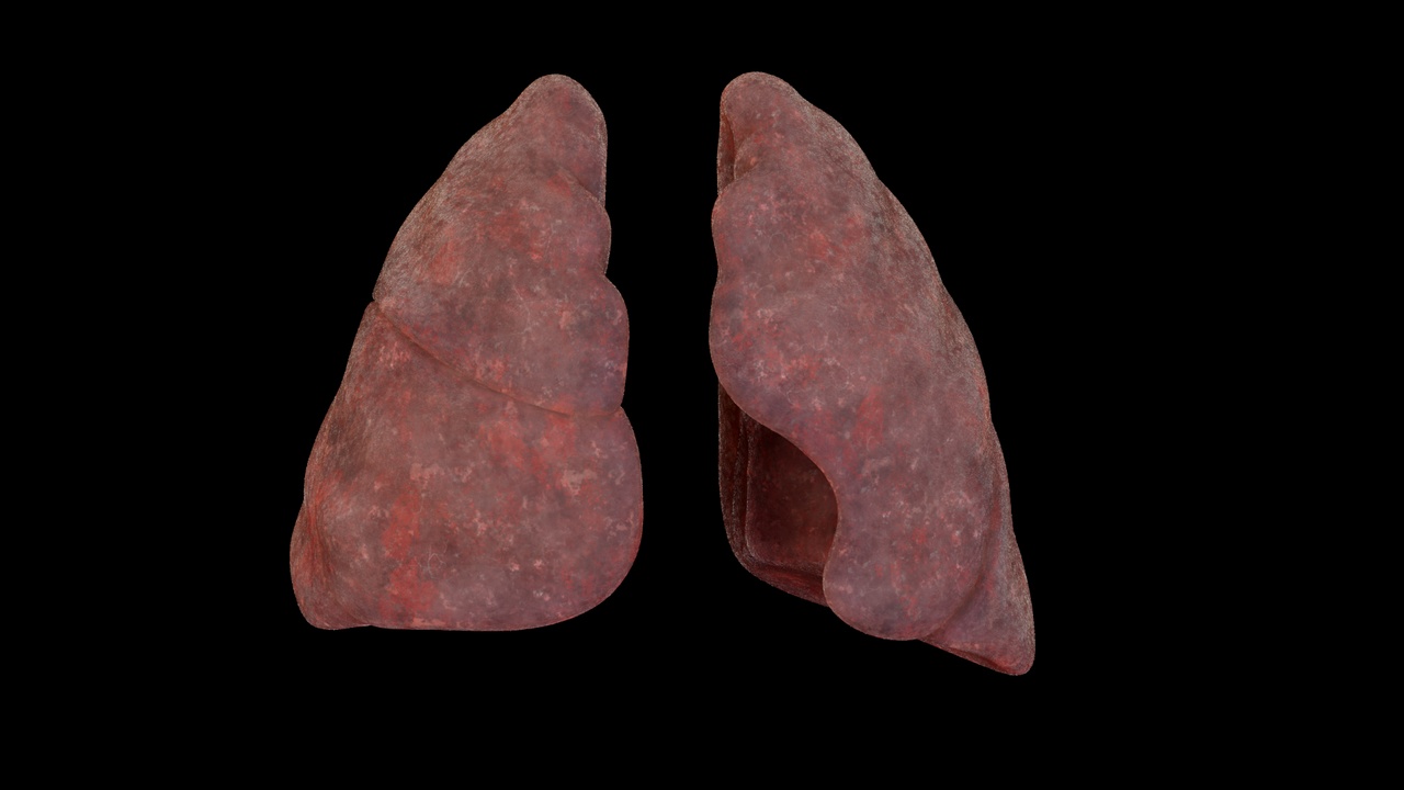 Media 1 for listing Smoker Human lungs