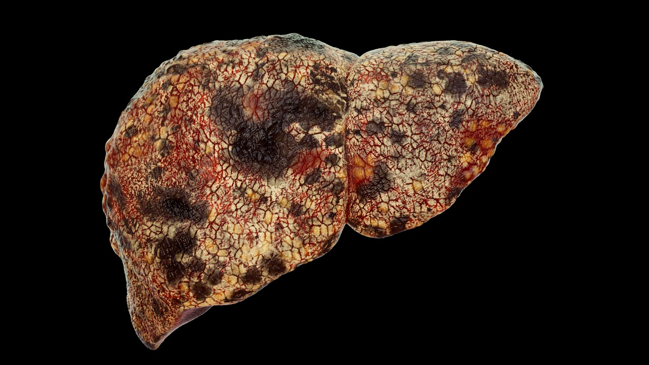 Media 1 for listing Liver cancer, liver disease, digestive system organs