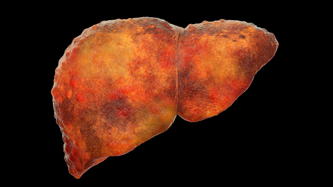 Media 1 for listing Liver cysts, liver disease, digestive system organs