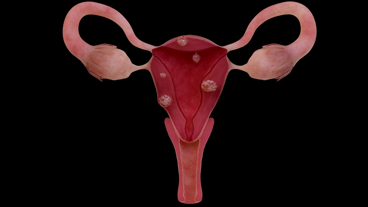 Media 1 for listing Anatomy features of diseased uterus, uterine fibroids, female ovaries, vagina