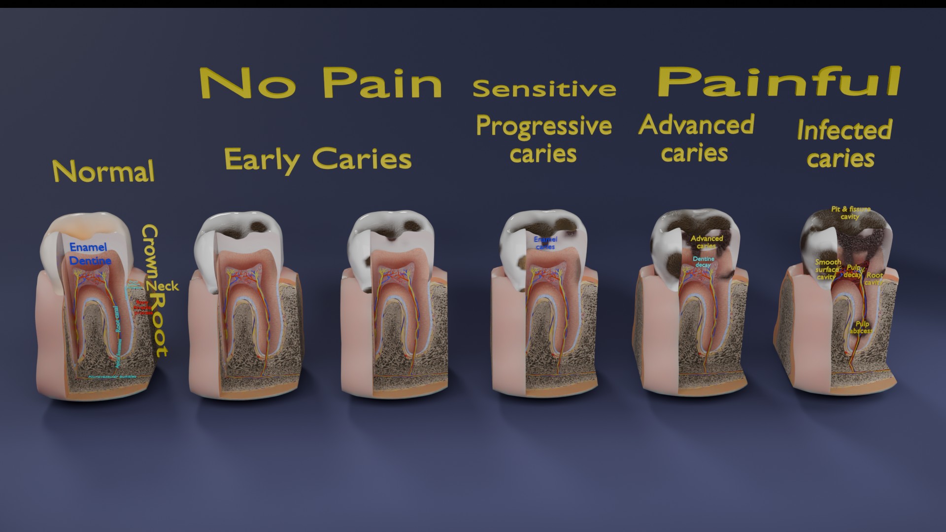 Caries Teeth severity schematic cut sectional | Fab