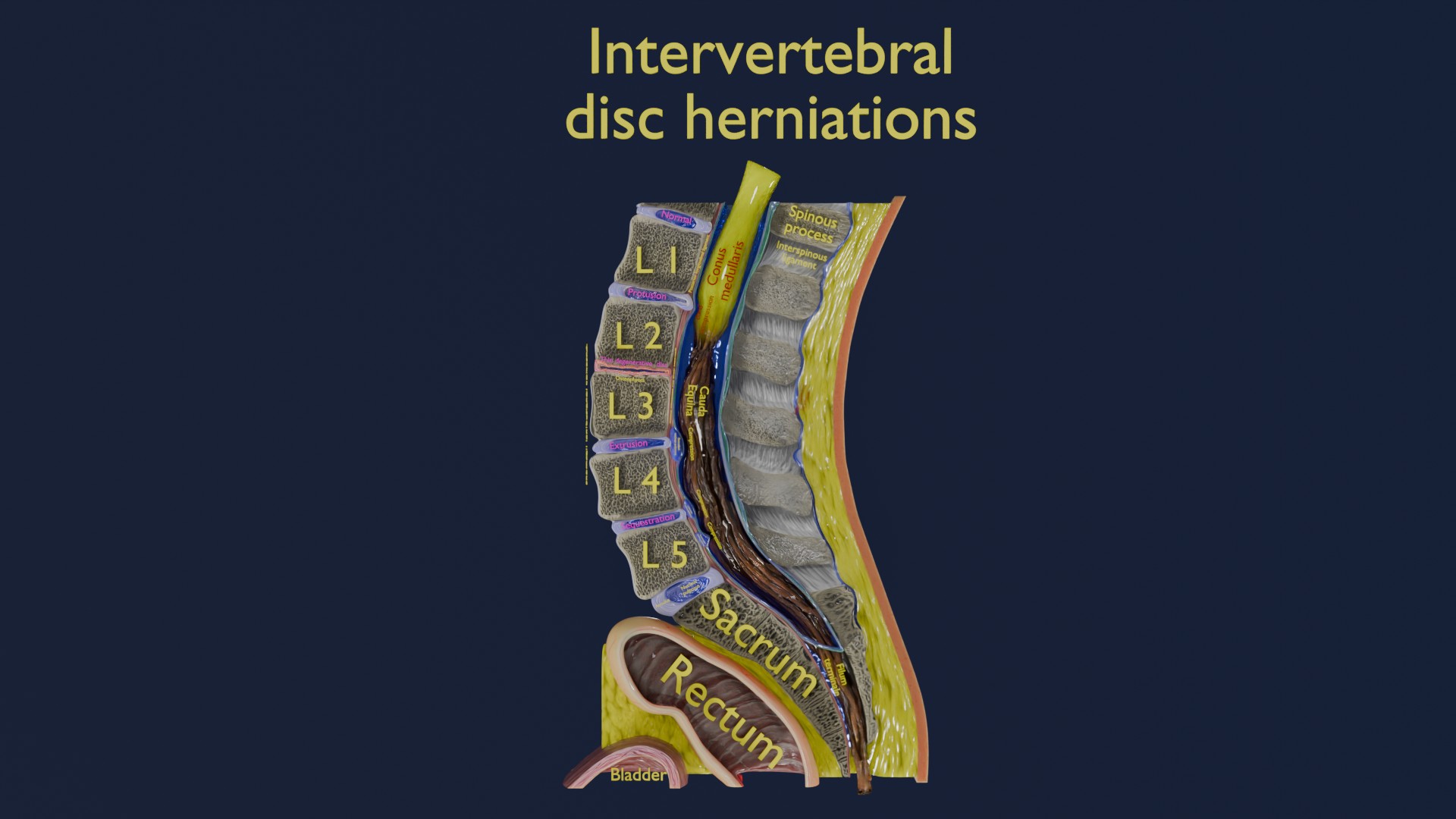 Intervertebral herniation slipped ruptured disc | Fab
