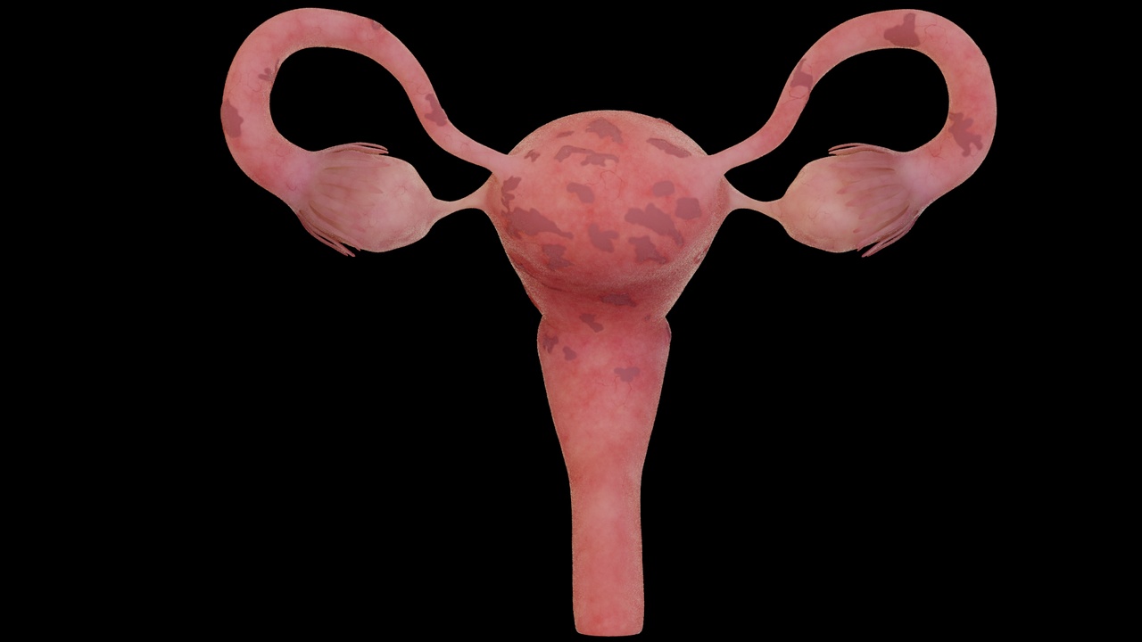 Media 1 for listing Uterine lesions, diseased uterus, uterine fibroids, gynecological diseases