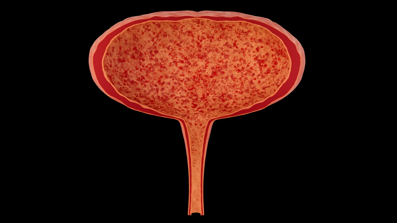 Media 1 for listing Cystitis, inflammation, urinary system diseases