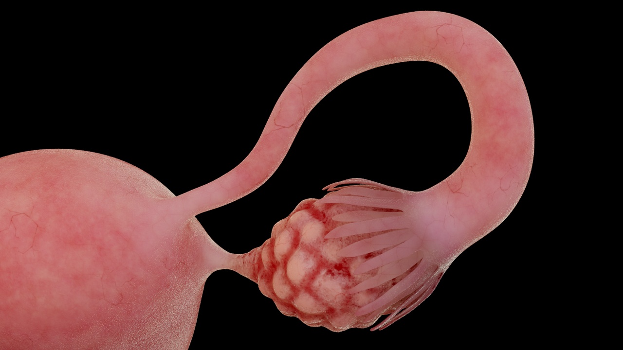 Media 1 for listing Ovarian cancer, ovarian cysts, uterine lesions, gynecological diseases