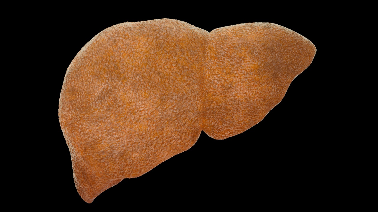 Media 1 for listing Cirrhosis, liver disease, digestive system organs