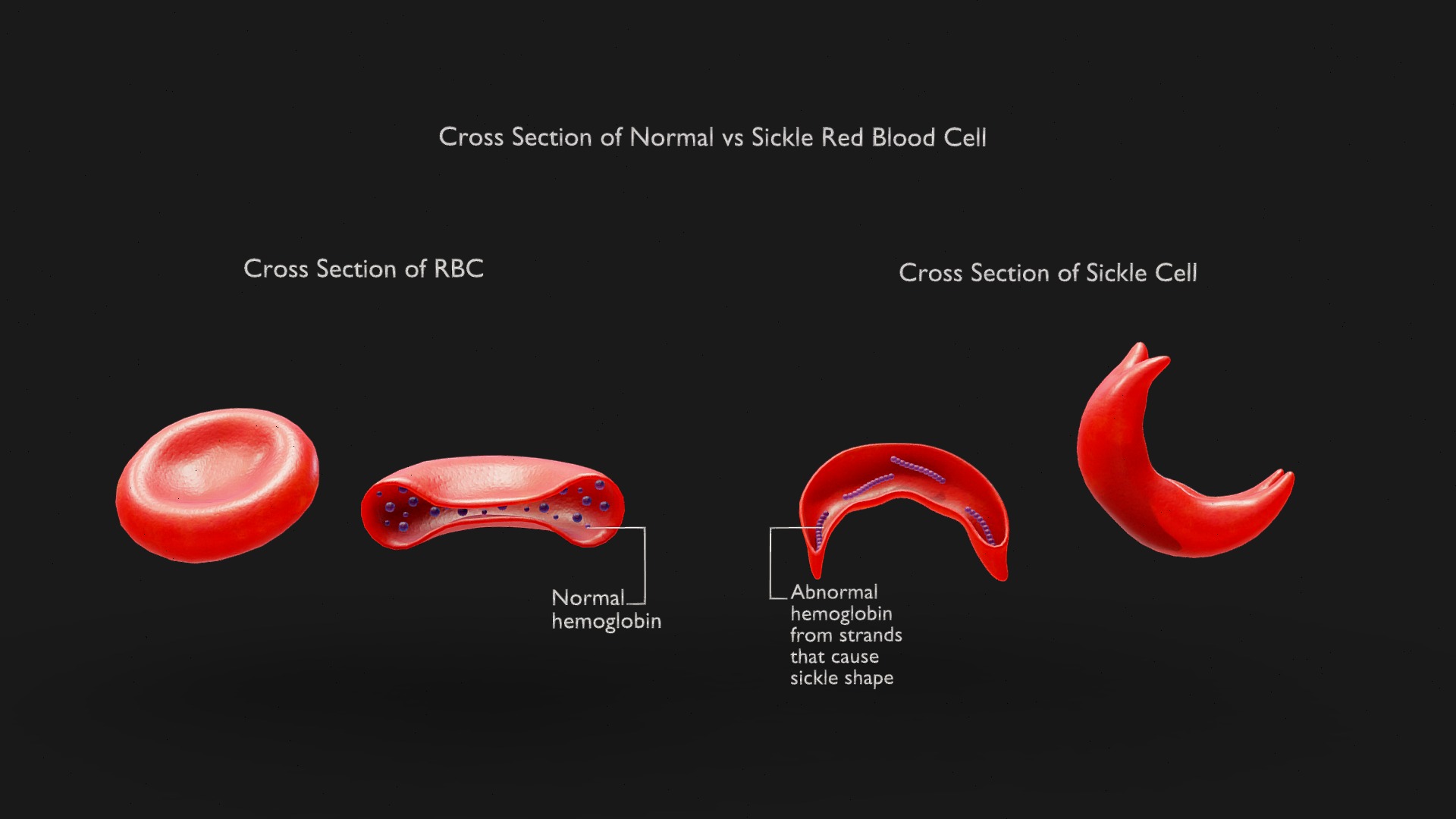 Normal vs Sickle Red Blood Cell Cross Section | Fab